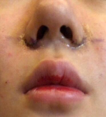 鼻頭鼻翼鼻尖整形恢復(fù)期全紀(jì)錄！分享果圖，蒜鼻姐妹pick me！