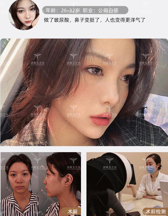 玻尿酸隆鼻果圖分享