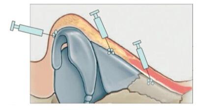 玻尿酸隆鼻費(fèi)用多少錢