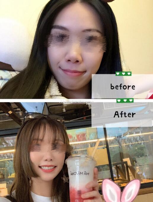 四川華西醫(yī)院口腔外科牙齒矯正案例分享