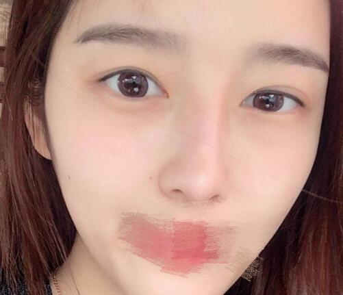 蔣小花醫(yī)生雙眼皮修復(fù)案例