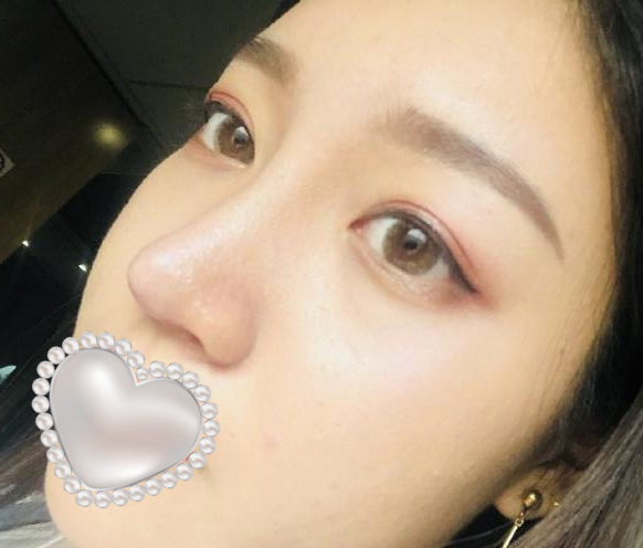 衡陽雅美姚江華醫(yī)生脂肪填充?案例