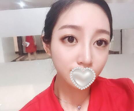 衡陽雅美姚江華醫(yī)生脂肪填充?案例