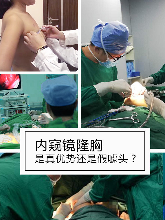 內(nèi)窺鏡德國(guó)vizaar威薩隆胸怎么樣