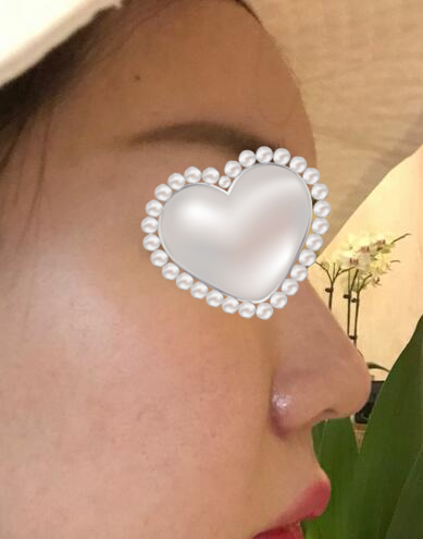 鼻翼縮小后果圖對比
