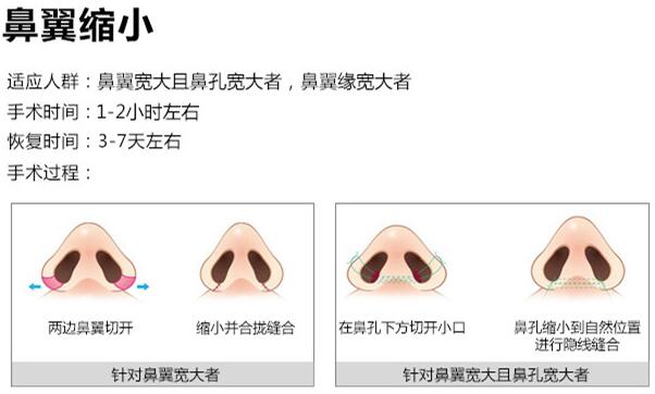 鼻翼縮小的二種摘除方法