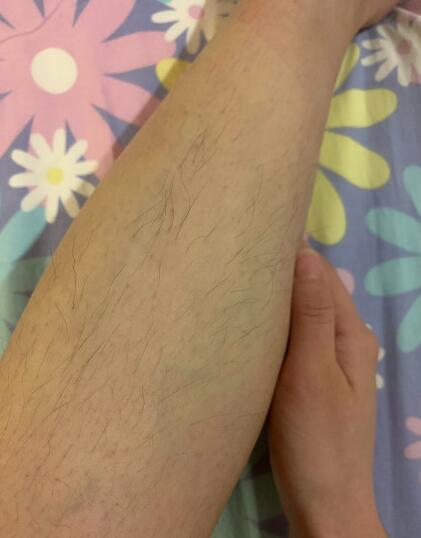 小腿激光脫毛體驗分享