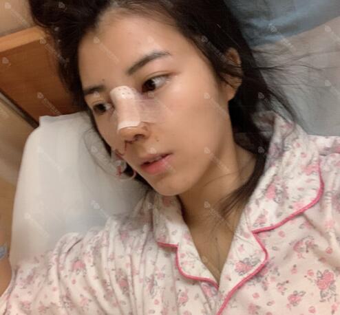 專業(yè)隆鼻整形手術(shù)體驗