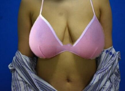 奧美定取出手術(shù)日記