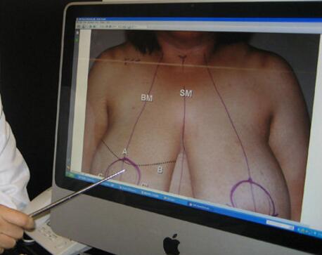 奧美定取出手術(shù)日記