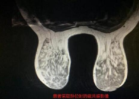 奧美定取出術(shù)后果圖