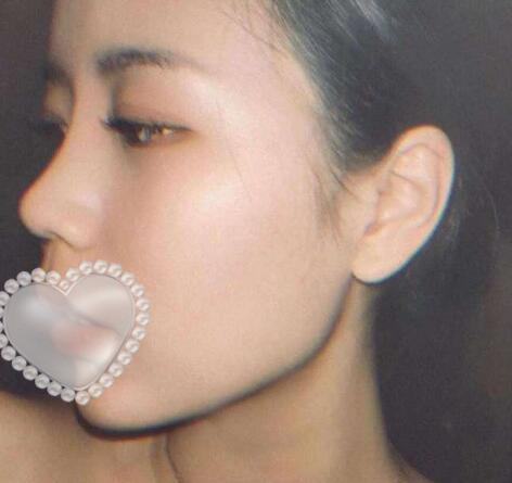 鼻尖整形對(duì)比圖