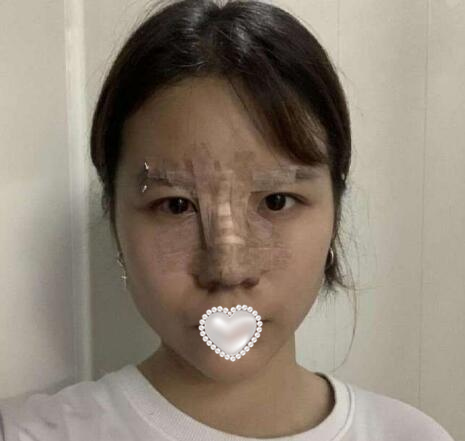 鼻尖整形手術(shù)分享