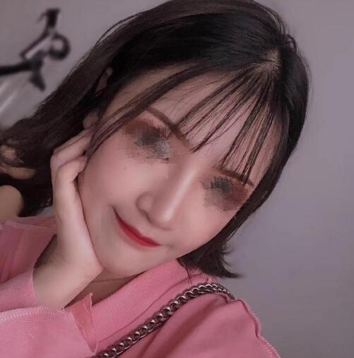 低鼻尖整形果圖對(duì)比