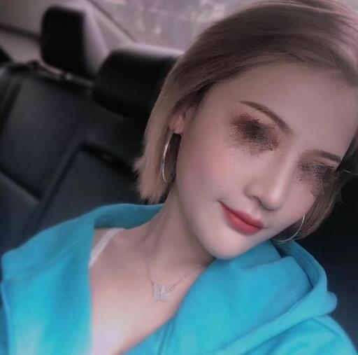 低鼻尖整形果圖對(duì)比