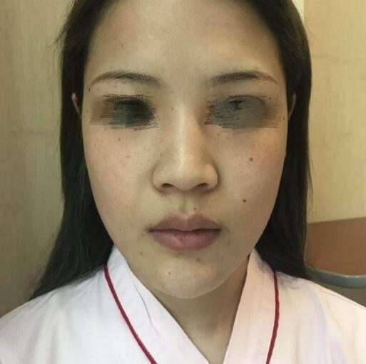 低鼻尖整形手術(shù)日記