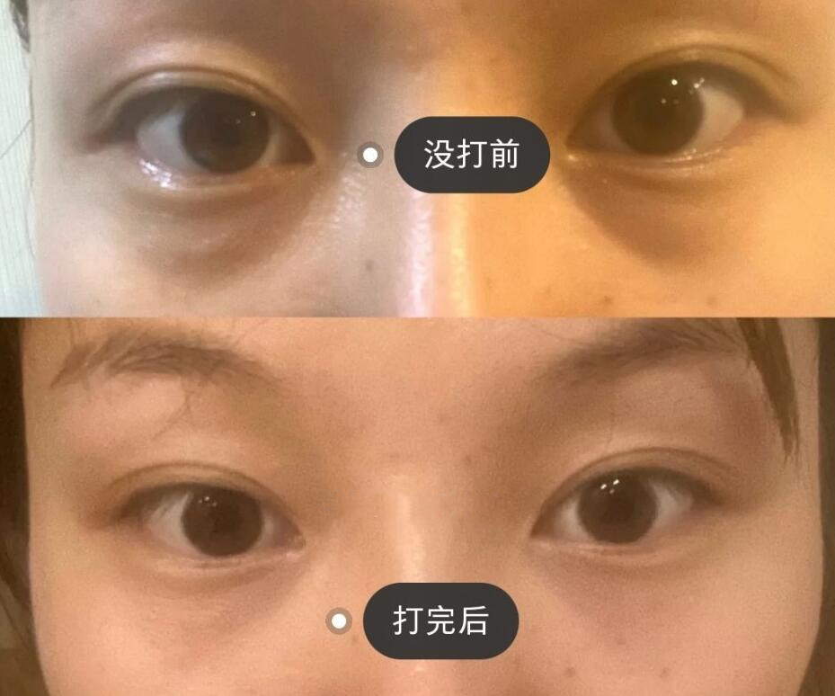 玻尿酸填充淚溝體驗日記