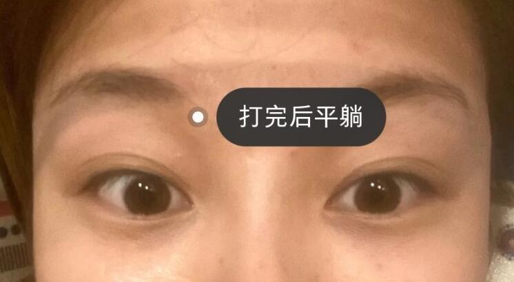 玻尿酸填充淚溝體驗日記