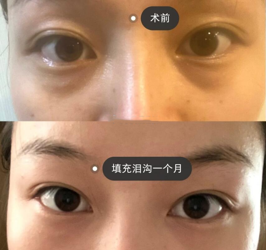 玻尿酸填充淚溝果圖