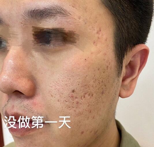 點陣激光如何去痘坑?