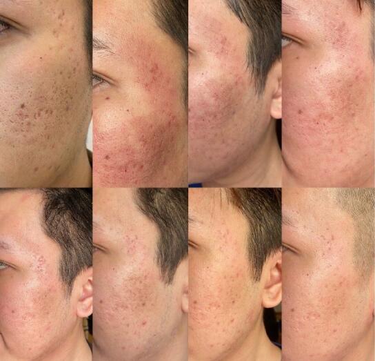 點陣激光如何去痘坑?