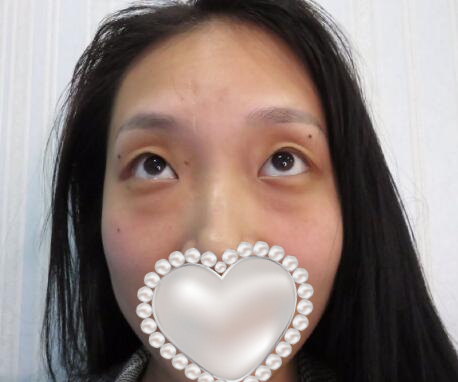 北京祛眼袋手術(shù)日記