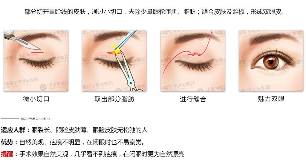 韓式三點(diǎn)式雙眼皮的成怎樣