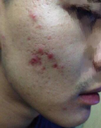 像素激光調節(jié)痘疤體驗日記