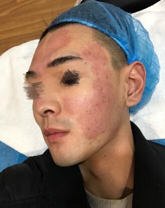 像素激光調節(jié)痘疤術后果圖