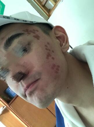 像素激光調節(jié)痘疤術后果圖