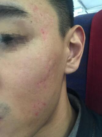 像素激光調節(jié)痘疤術后果圖