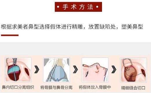 做隆鼻手術(shù)好嗎