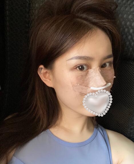 做隆鼻手術(shù)體驗日記