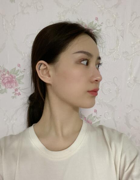 做隆鼻手術(shù)體驗日記