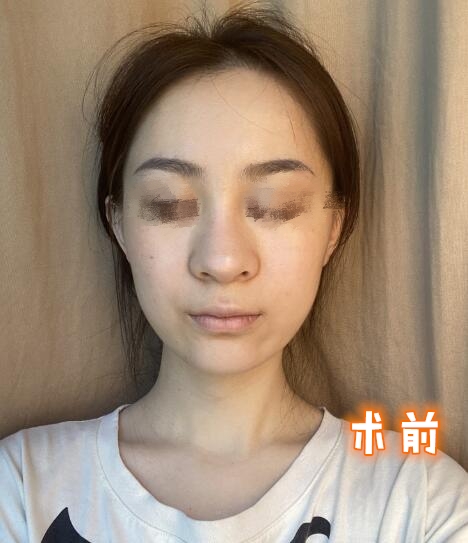 做隆鼻手術(shù)體驗日記