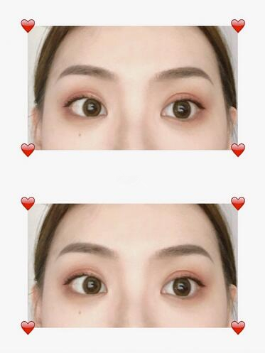 四、眉部整形紋眉手術(shù)果圖?