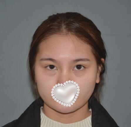 威塑吸脂面部果圖