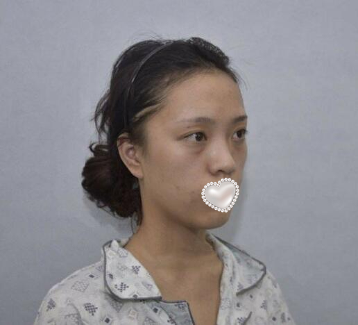 透明質(zhì)酸注射除皺果圖分享