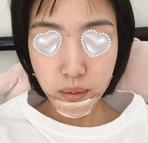 膨體隆下巴果圖分享