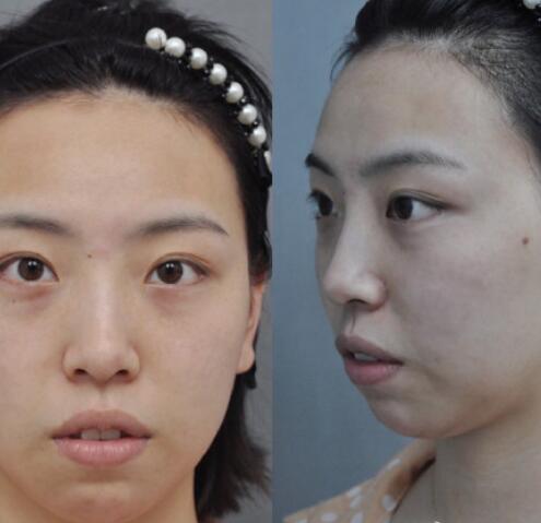 膨體隆下巴果圖分享