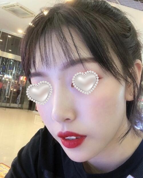 膨體隆下巴果圖分享