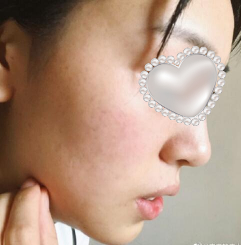 膨體隆下巴果圖分享