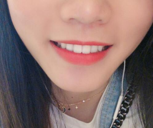 上海九院種植牙術(shù)后果圖