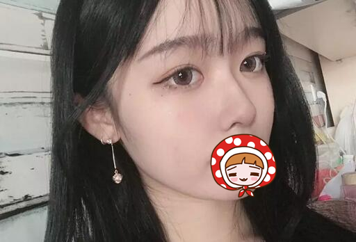 北京硅膠隆鼻手術(shù)果圖