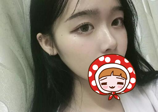 北京硅膠隆鼻手術(shù)果圖