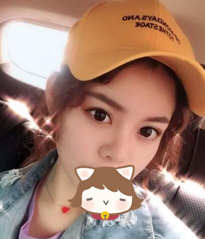 玻尿酸隆鼻前后對比分享