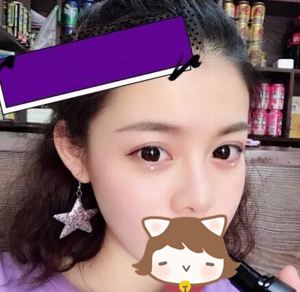 玻尿酸隆鼻前后對比分享