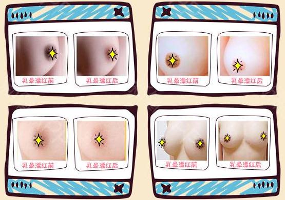 乳暈漂紅手術(shù)注意事項(xiàng)