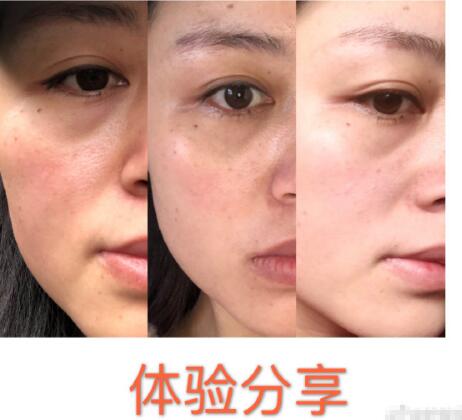 光子嫩膚果怎么樣