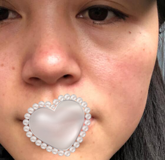 光子嫩膚果怎么樣